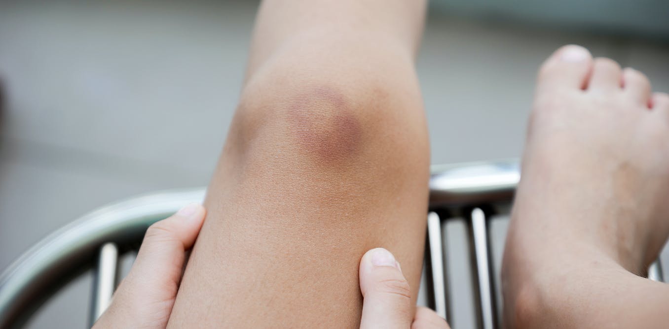 5 Effective Ways to Get Rid of Bruises