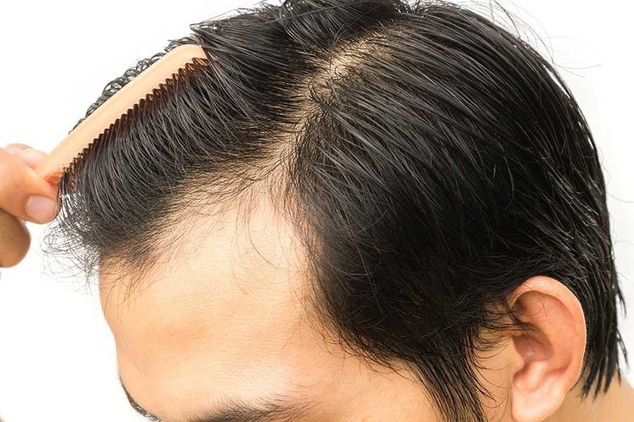 is-hair-transplant-permanent-495b84a2