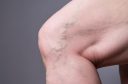 5 Myths About Varicose Veins You Need to Stop Believing-26d441c0