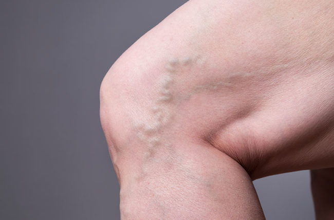 5 Myths About Varicose Veins You Need to Stop Believing-26d441c0