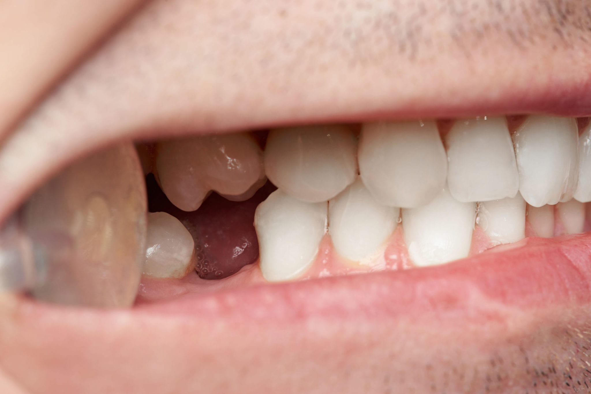 Your 3 Best Options for Replacing Missing Teeth