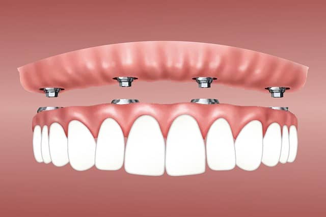 10 Facts You May Not Know About All on 4 Dental Implants