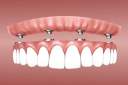 10 Facts You May Not Know About All on 4 Dental Implants