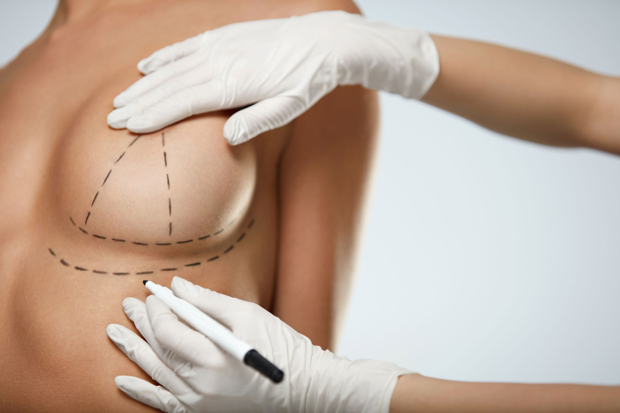 8 Things to Know about Breast Lift