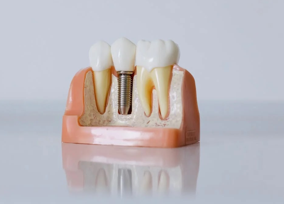 What Is the Difference Between the Materials of Dental Implants