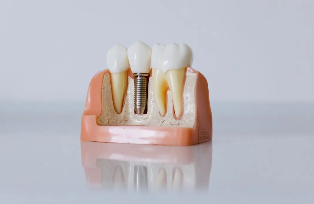 Dental Implant Options For Patients With a Significant Bone Loss