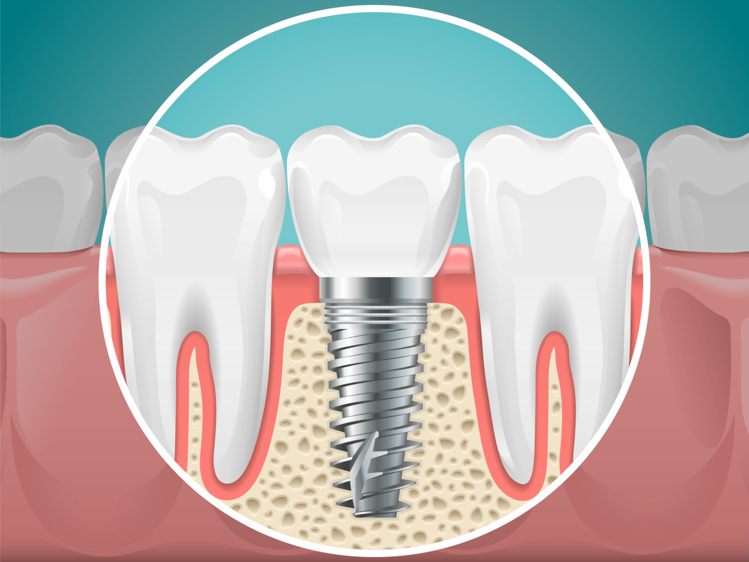 7 Myths About Dental Implants Debunked