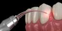 Laser Gum Surgery 101 How This High-Tech Solution Is Revolutionizing Gum Disease Treatment